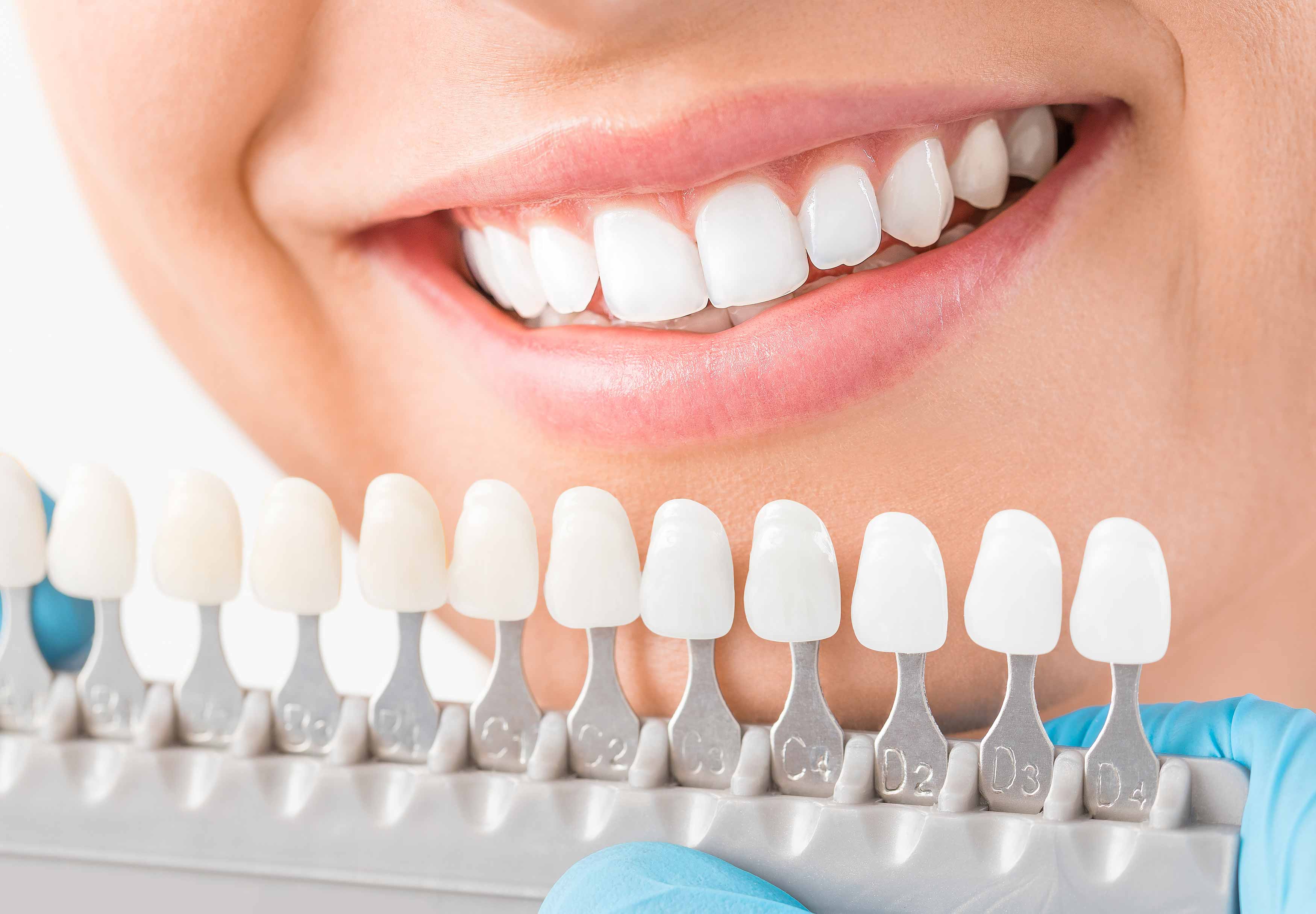 Photo showing a person's wonderful white smiling teeth with a toothshade tab next to the teeth