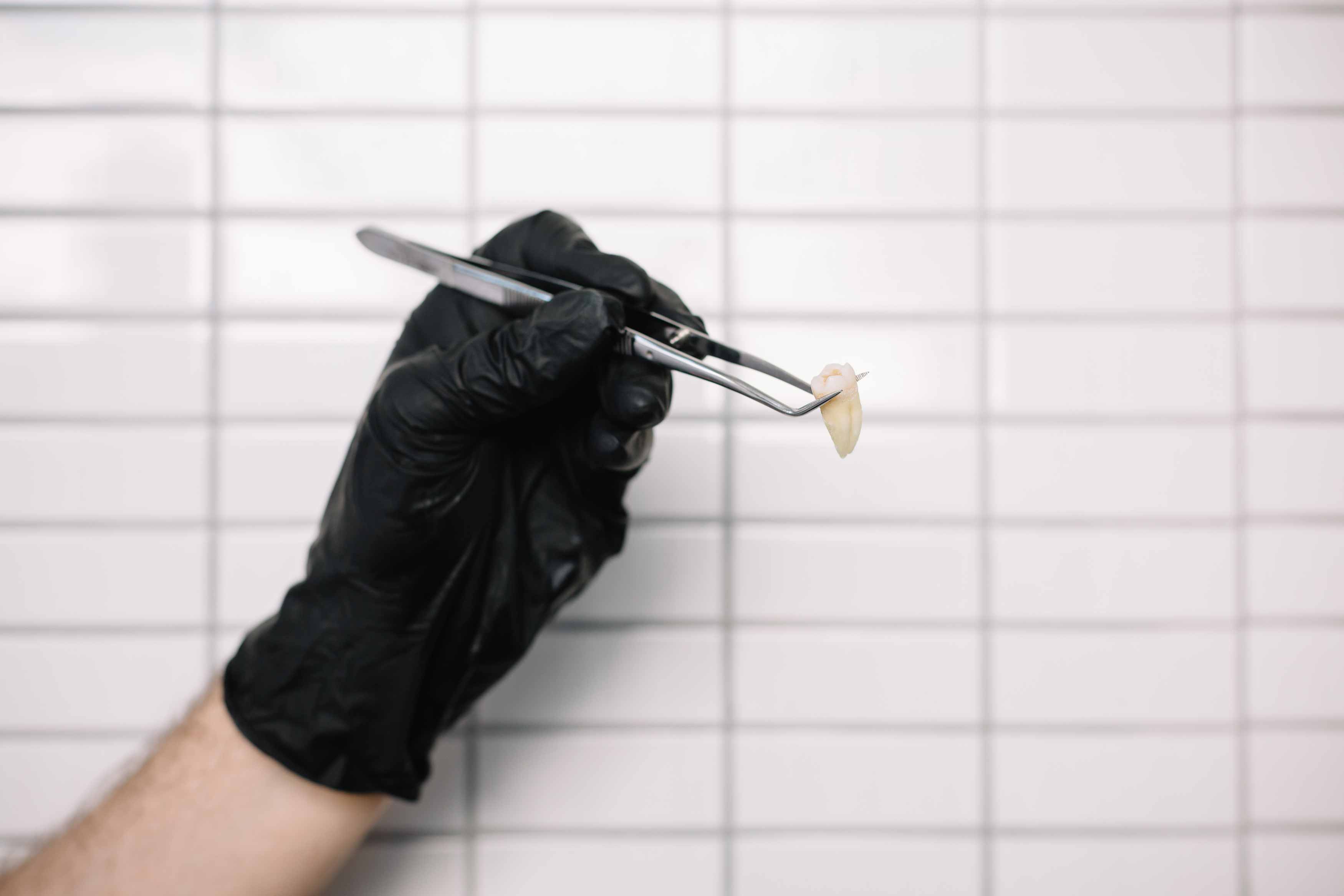 Photo of someone's gloved hand holding up a wisdom tooth with a pair of tweezers