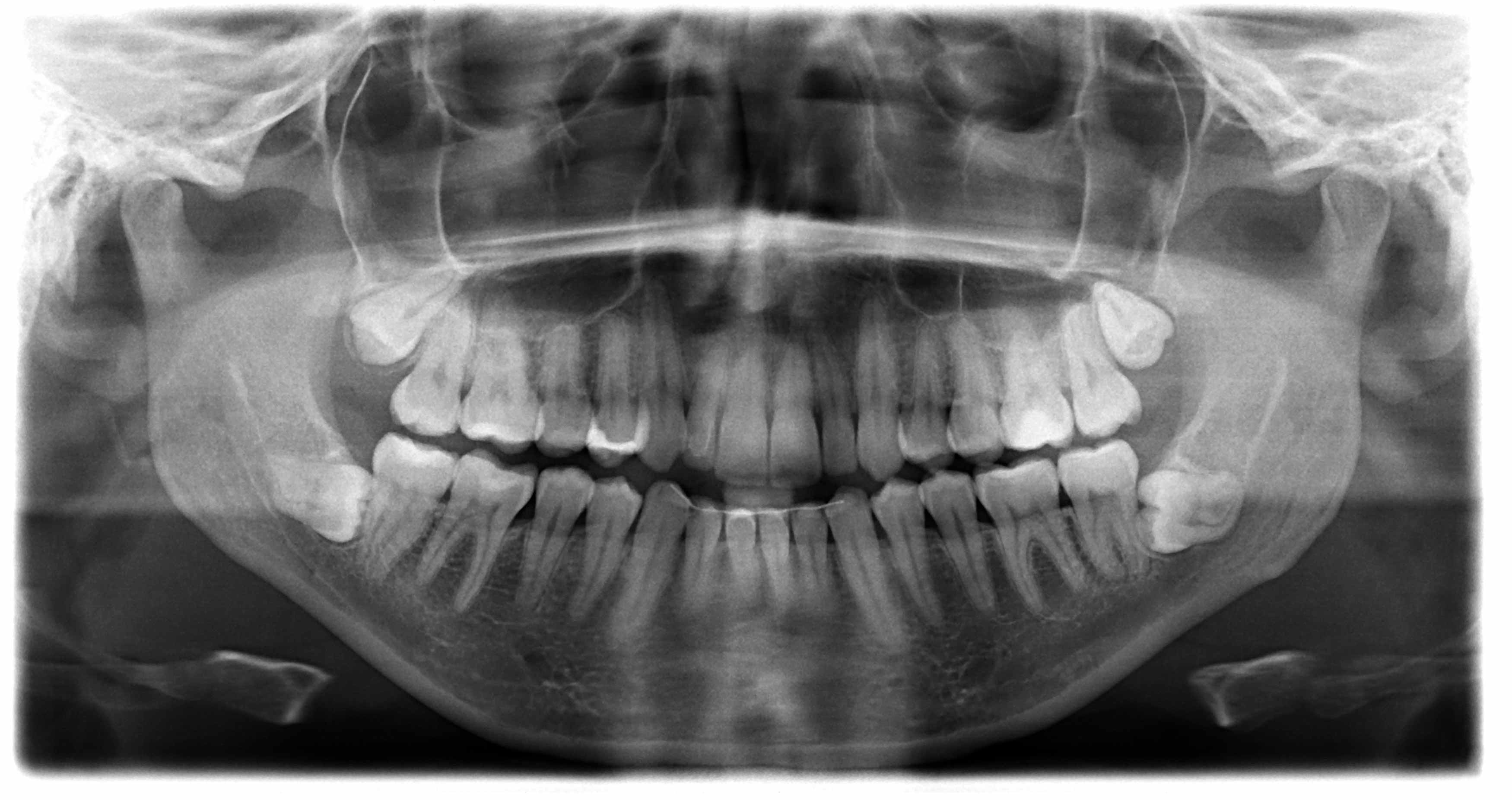 An OPG Xray of someone's mouth showing all four of the wisdom teeth horizontally impacted against the adjacent teeth. 