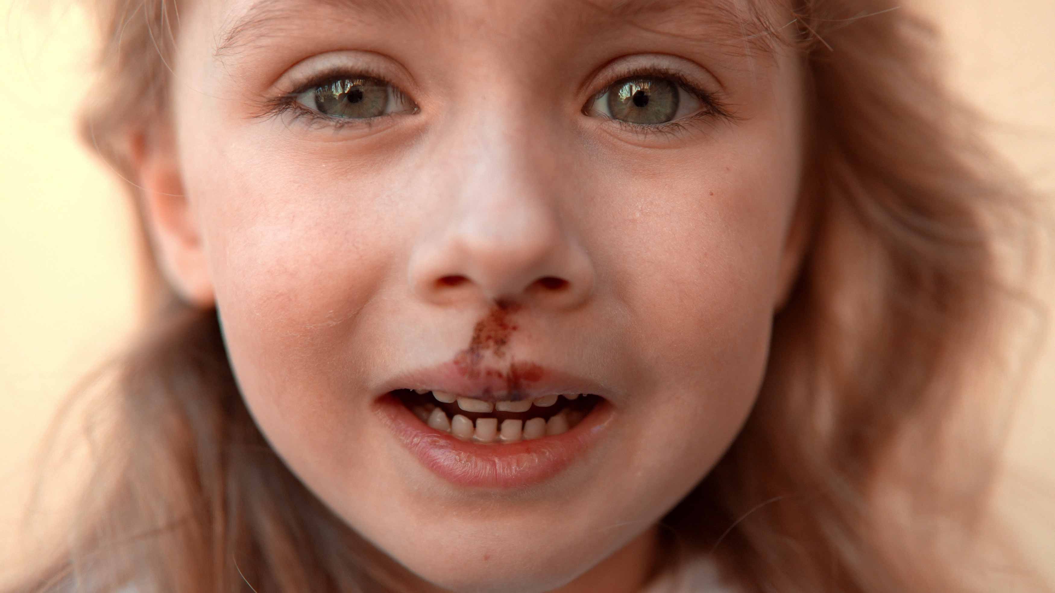 Photo of a girl crying with blood in his mouth after a fall