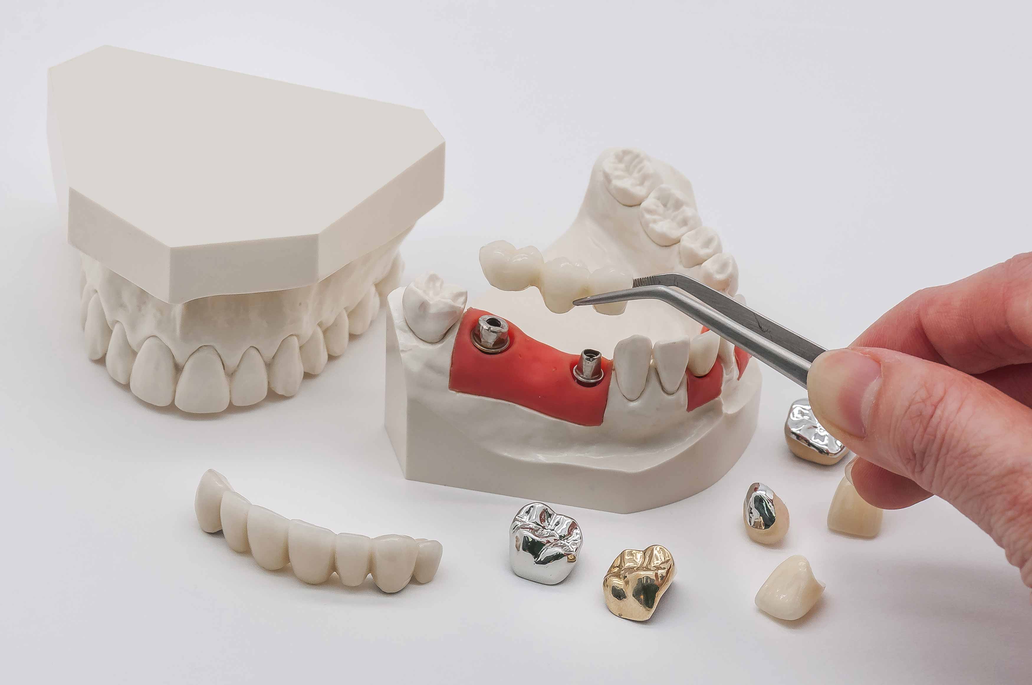 Photo of an implant-supported dental porcelain bridge 