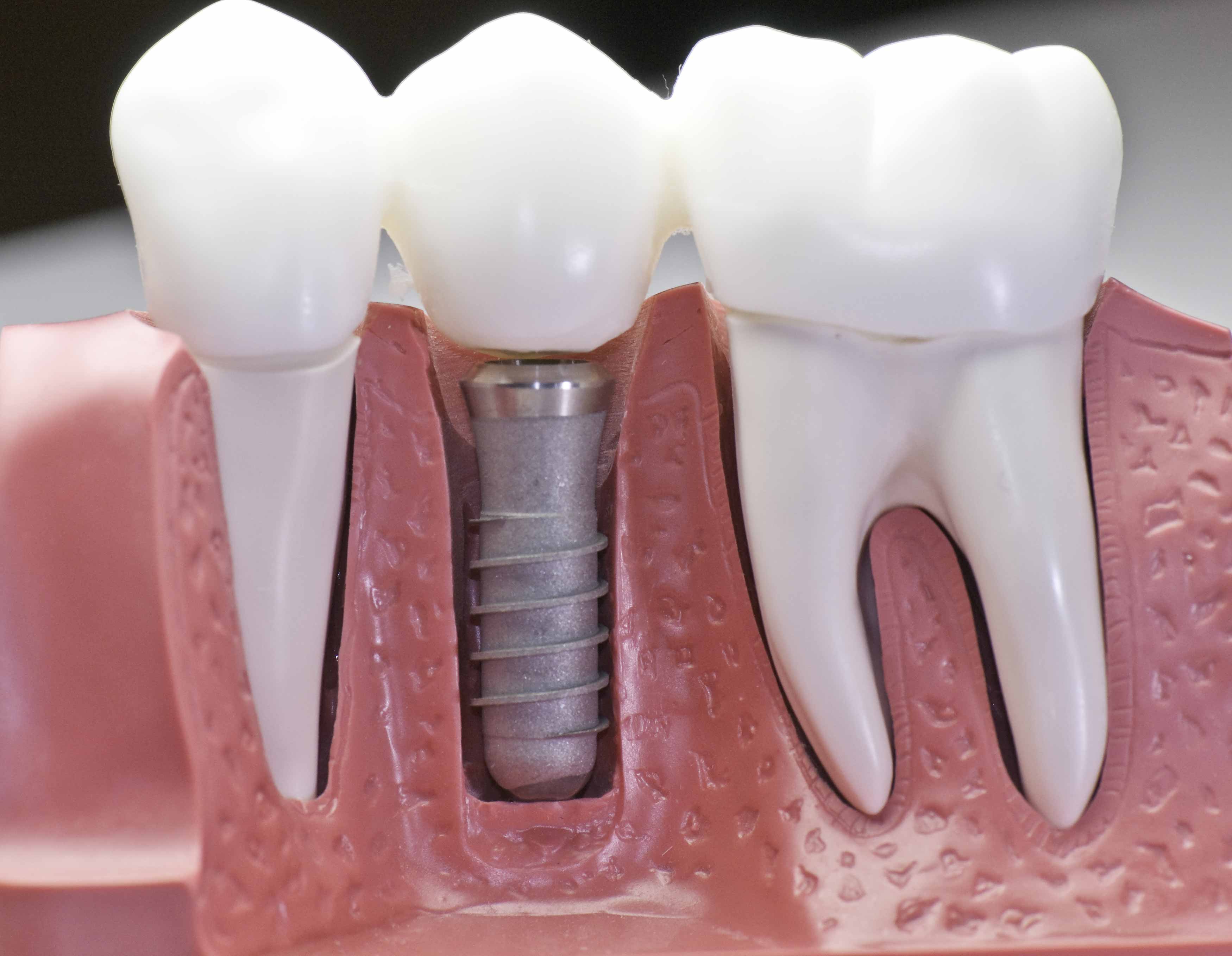 Photo of a model of a dental implant tooth compared to normal teeth