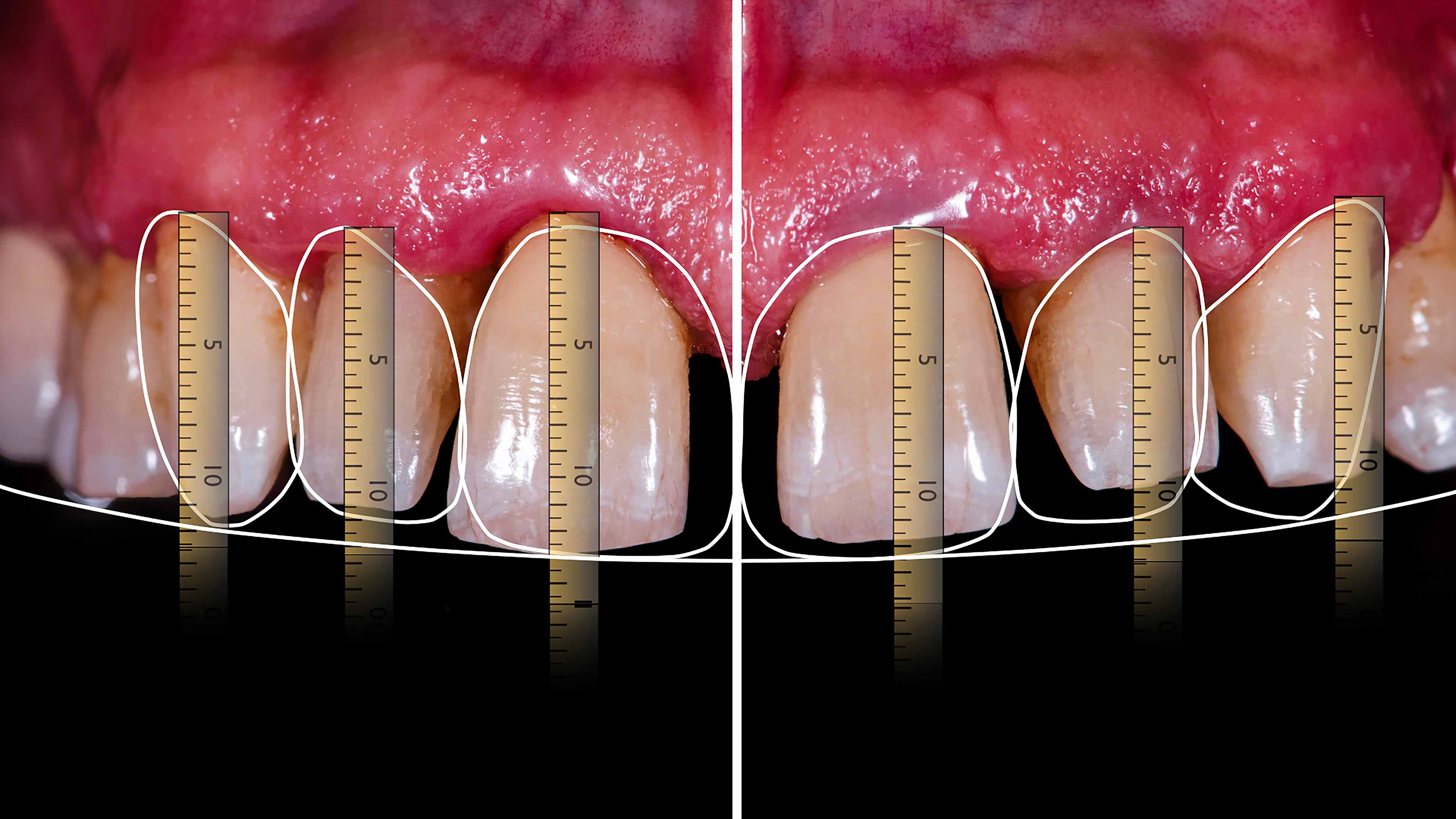  Photo of a mockup of an ideal toothshape compared to the existing worn teeth. 