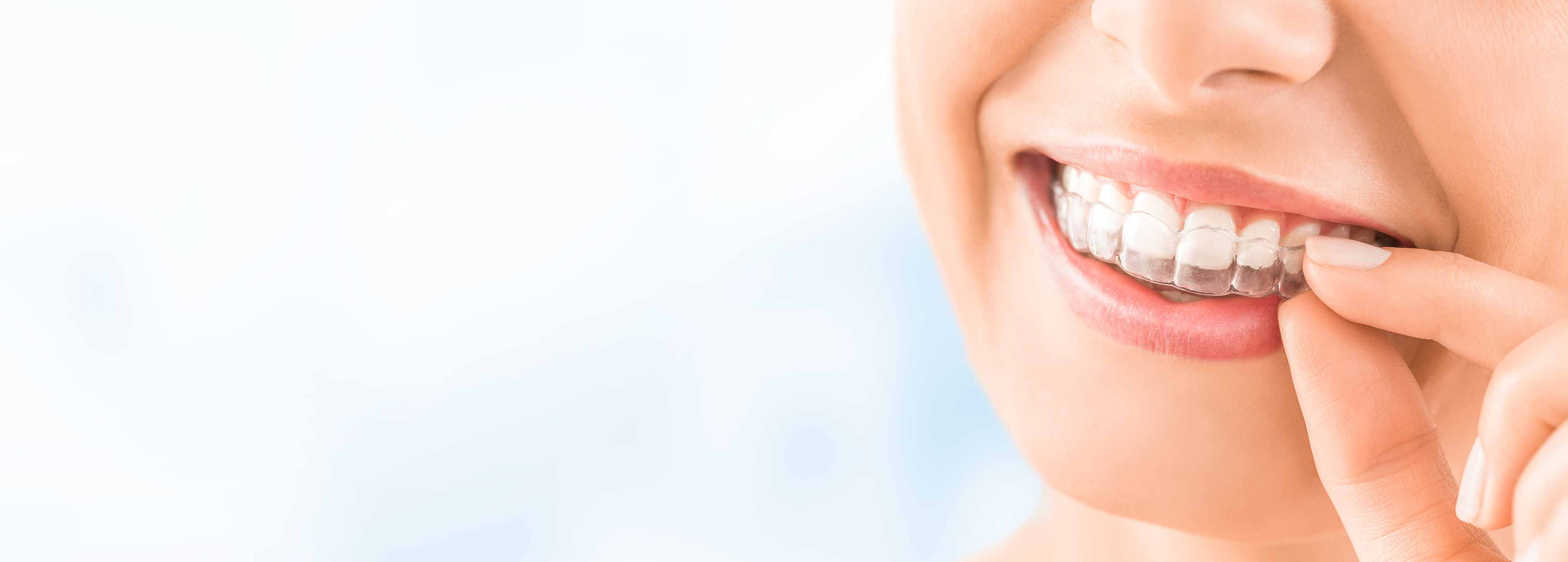 A photo of a female putting her upper clear aligners on her top teeth