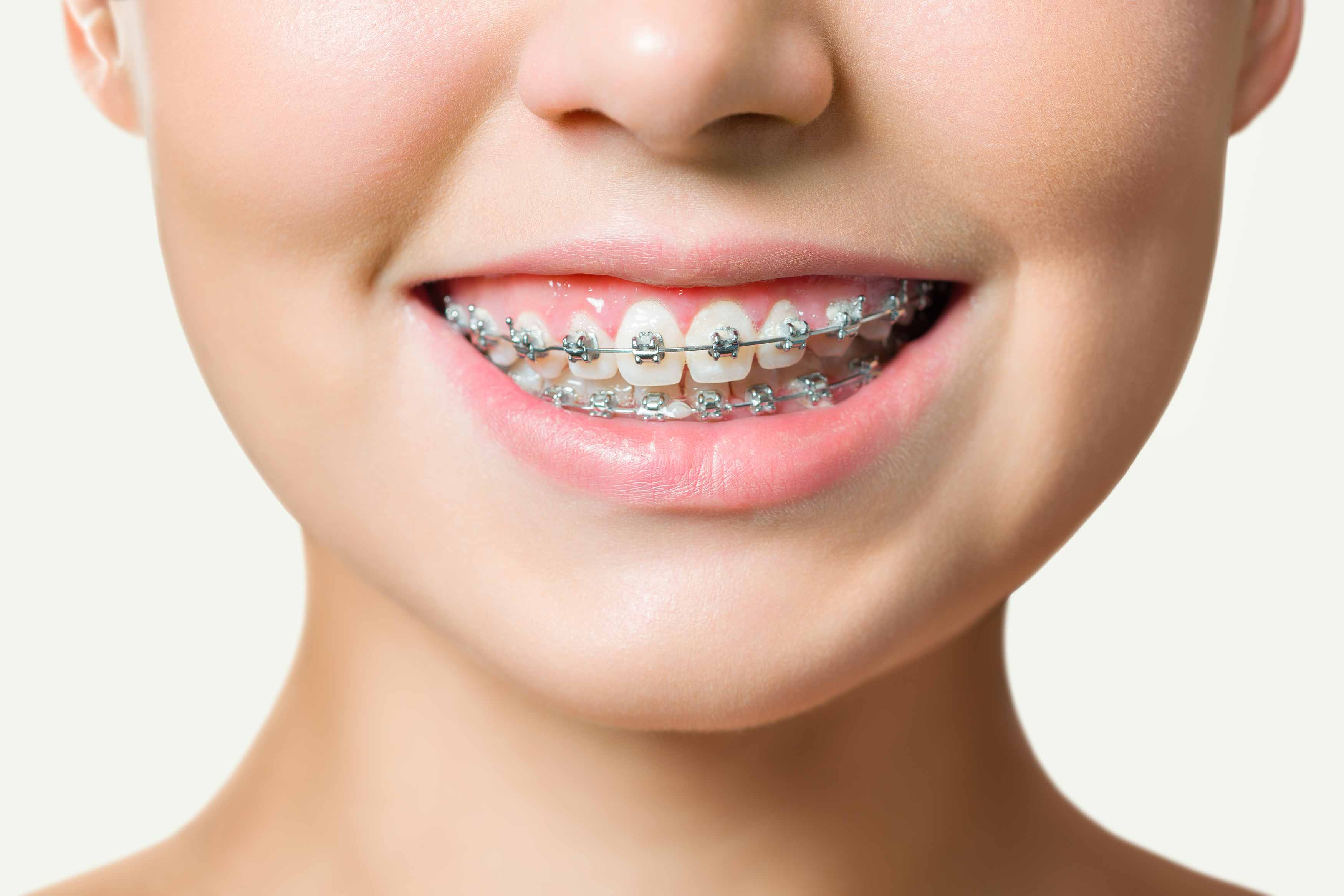 A photo of a female smiling and showering her orthodontic braces on her teeth