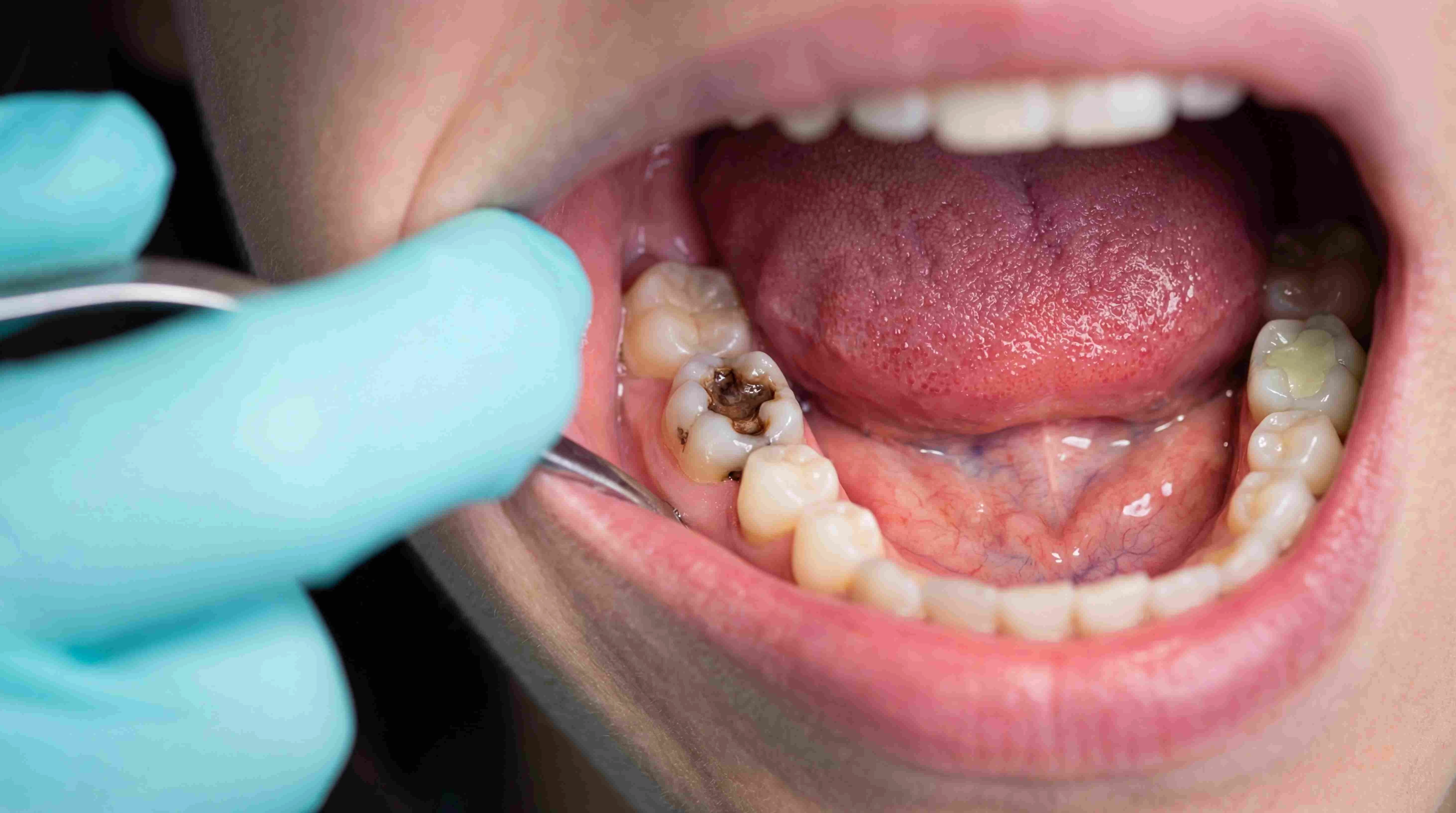 Small tooth cavity that may need a filling