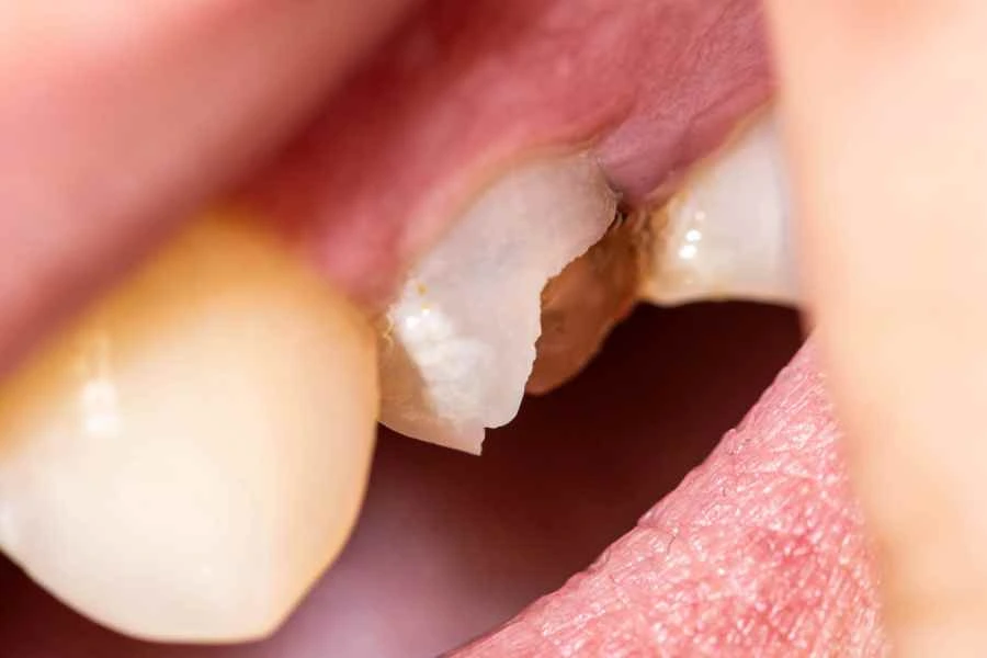 Dental bonding repair for a chipped front tooth