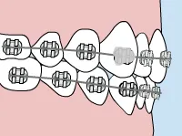 loose bracket - emergency care - Bettagere Orthodontics