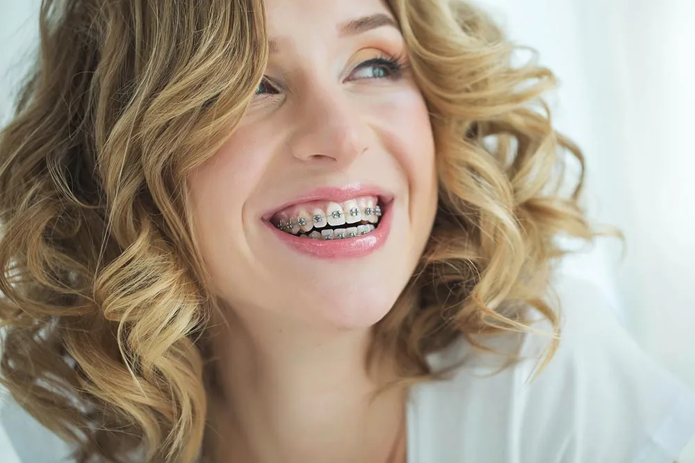 traditional metal braces - Bettagere Orthodontics