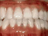 underbite - after treatment