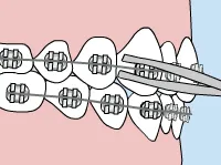 Loose wire - braces- emergency care - Bettagere Orthodontics