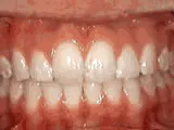 overjet - after treatment