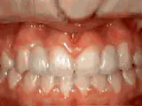 missing lateral incisors - after treatment