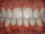 crowding of the teeth - after treatment