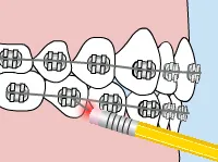 poking wire - braces - emergency care - Bettagere Orthodontics