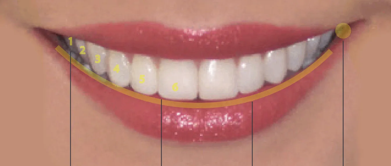 12 tooth smile showing natural smile arc in orthodontic treatment