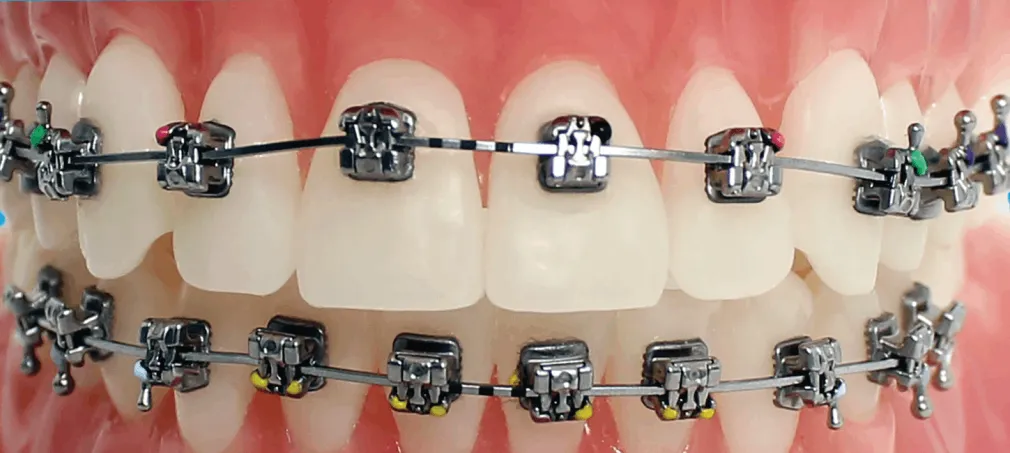 sap/vid bracket placement