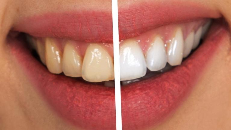 https://www.clarksondentalgroup.com/thedentalsitecontent/1002498/blog/medium_How-Effective-Are-Teeth-Whitening-Toothpastes_2020531123650_16.jpg