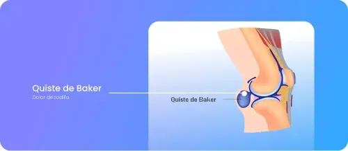 quiste baker rodilla