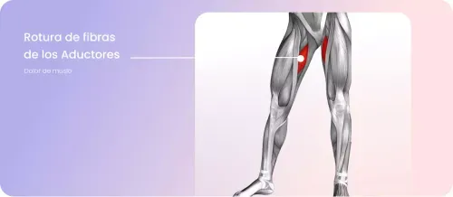 rotura fibras aductores