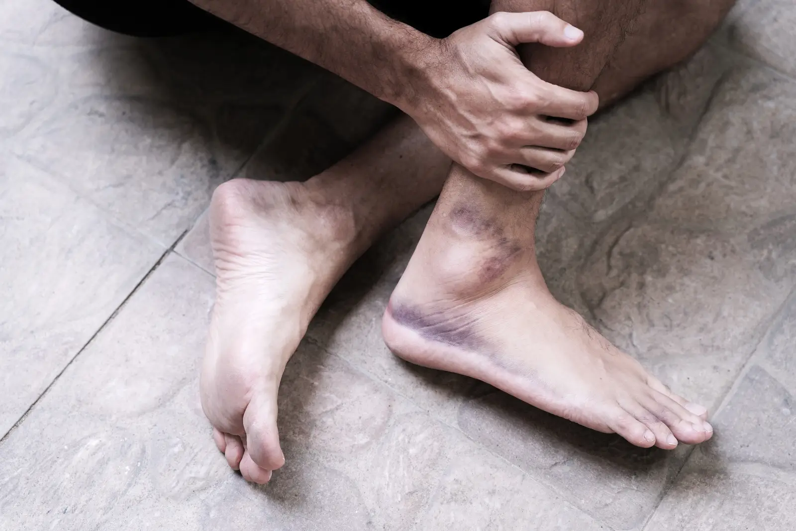 picture of a young man injured holding with his hand the ankle while being bruised,