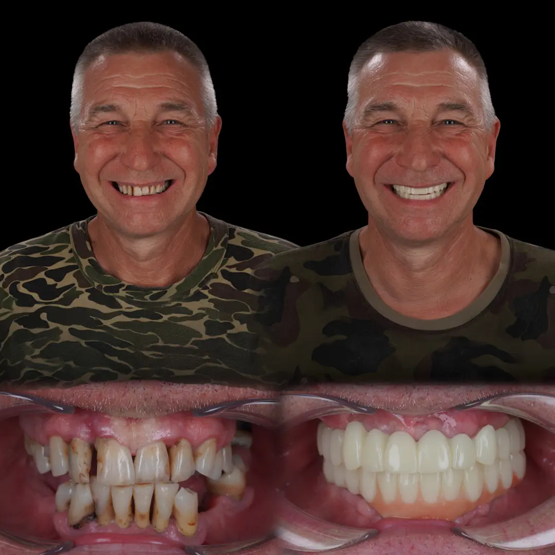 Recuperare după implant dentar: tot ce trebuie să știi