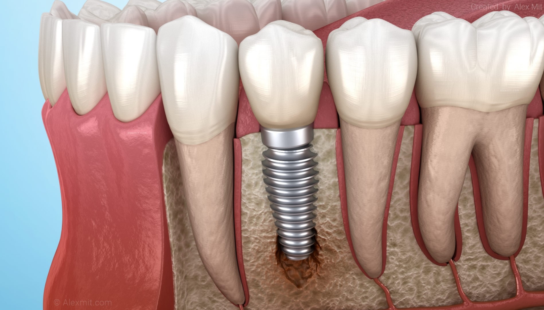 Infecție implant dentar: Ghid complet de tratament