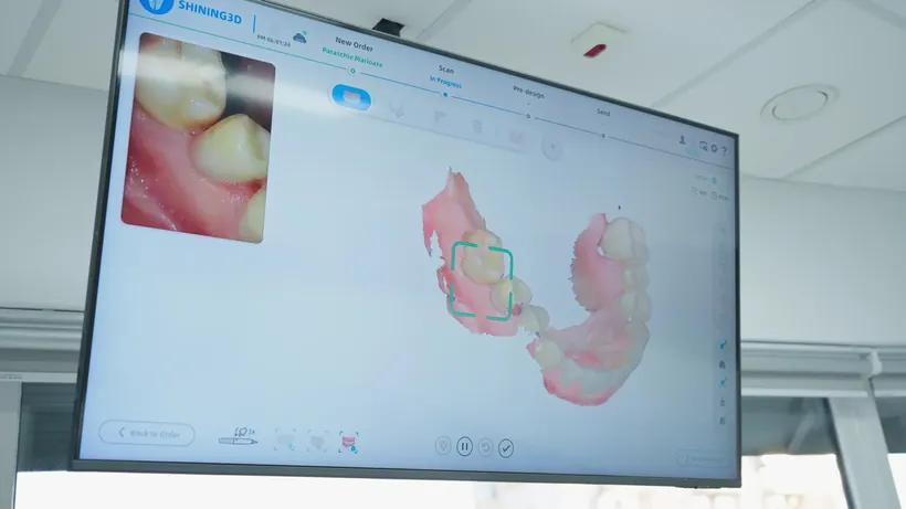 Amprentă digitală 3D din scanerul intraoral, pe ecran