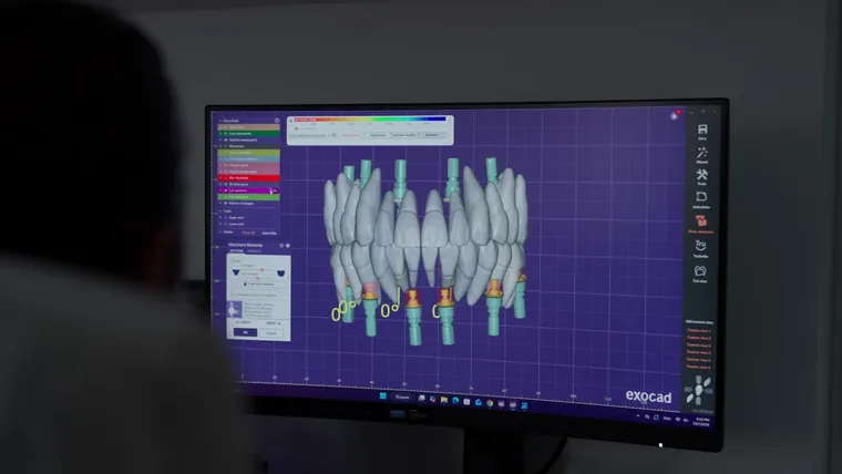 Proiectarea digitală a unei lucrări pe implanturi, la DentalCare Sîrbu