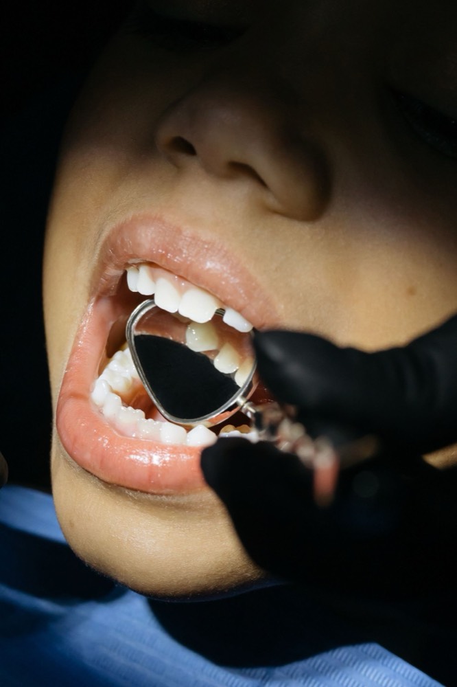 Sealants and Fluoride: The Two Simplest Ways to Keep Clifton Kids Cavity-Free