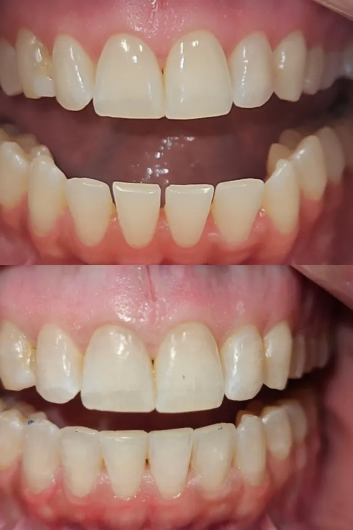 Gaps closed for a seamless smile line