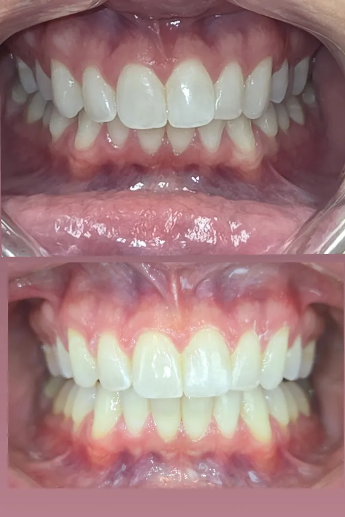 Crowding resolved for a cleaner look