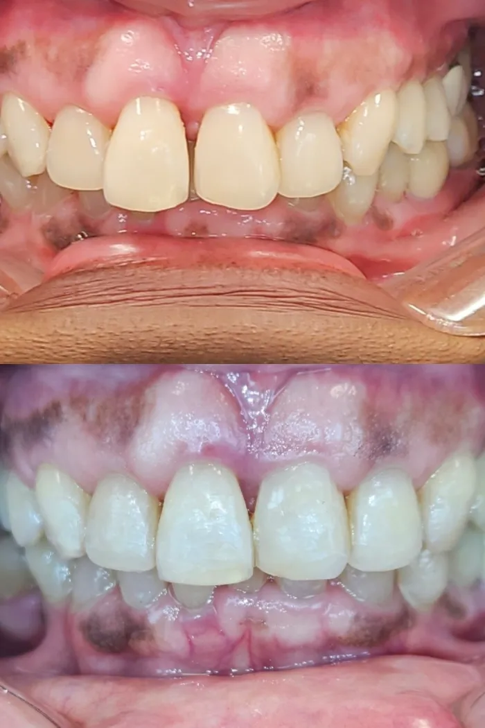 A natural-looking, complete smile