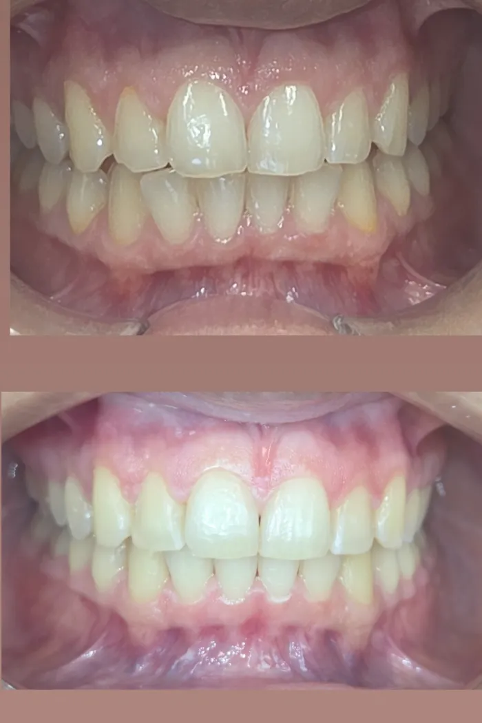 Straighter, more uniform teeth