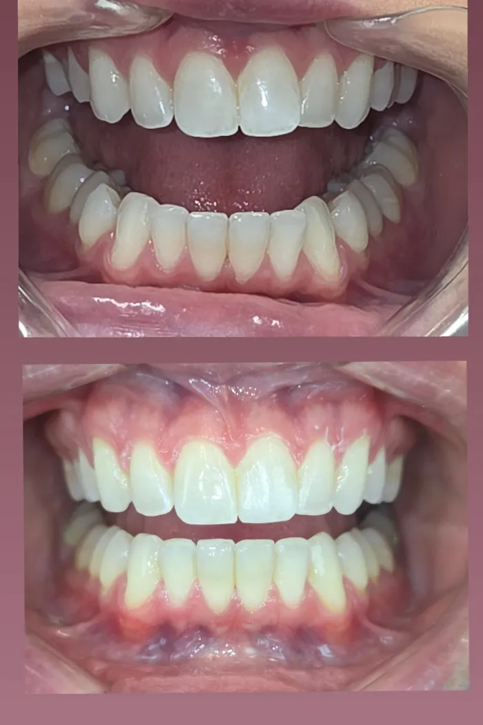 Teeth now meet comfortably and evenly