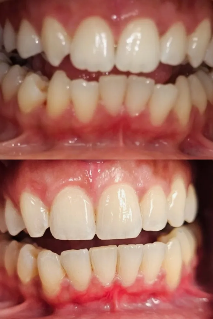 Brighter, more even tooth color