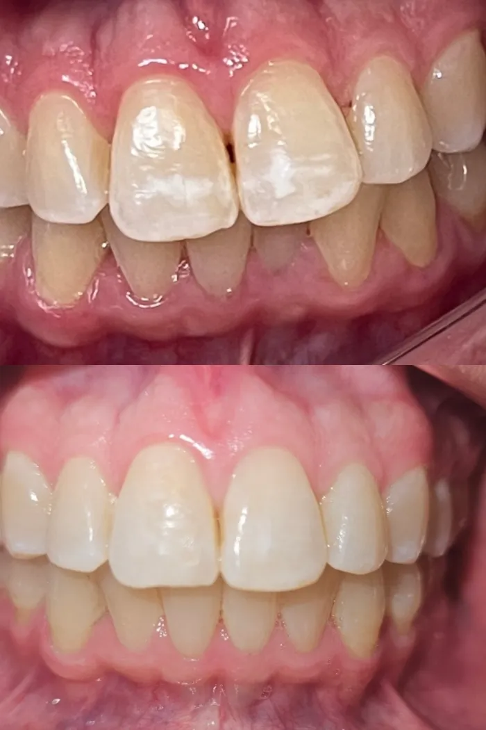 Subtle refinements, natural results