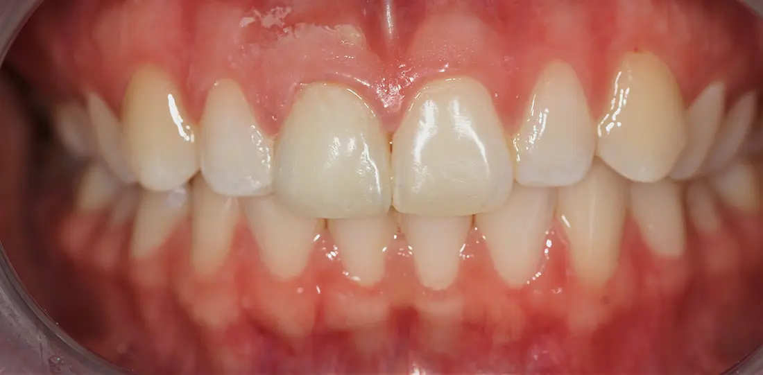 Close-up of clean, healthy upper and lower front teeth with pink gums visible.
