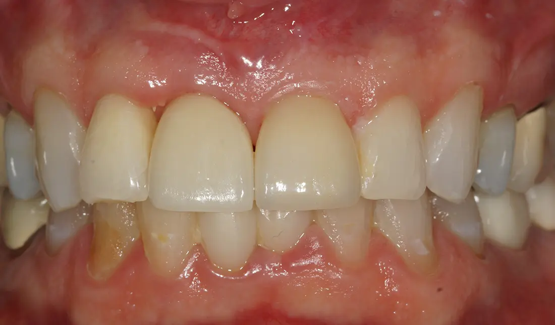 Close-up of upper and lower front teeth showing dental crowns and natural teeth with gums visible.
