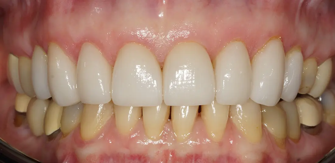 Close-up of upper front teeth with dental crowns, contrasting with natural lower teeth.