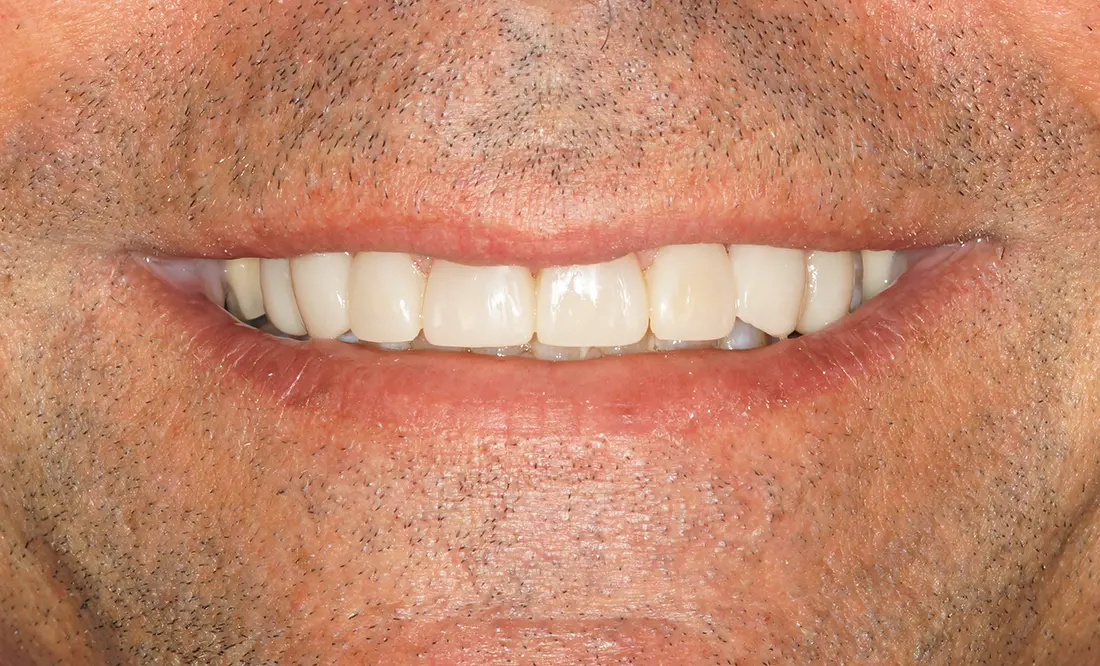 Close-up of a closed-lip smile showing clean, evenly aligned teeth with facial stubble.