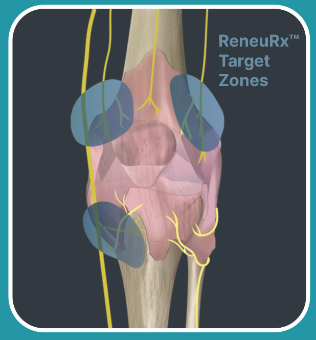 Illustration of a knee showing the ReneuRx therapy Target Zones