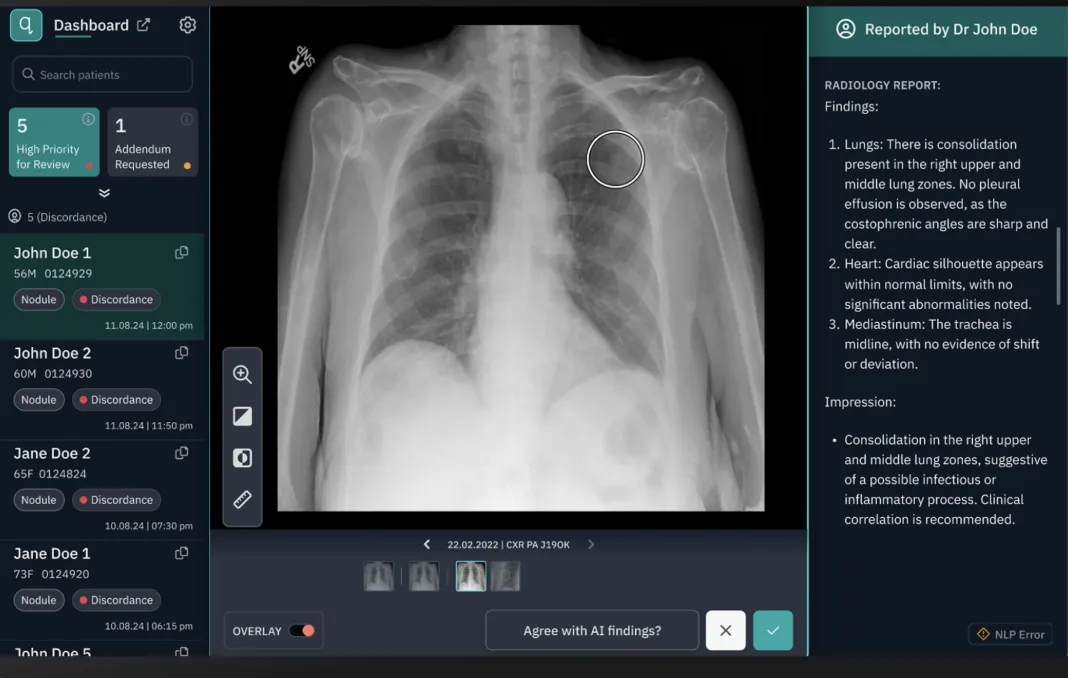 university-hospitals-cleveland-taps-ai-for-early-lung-cancer-detection