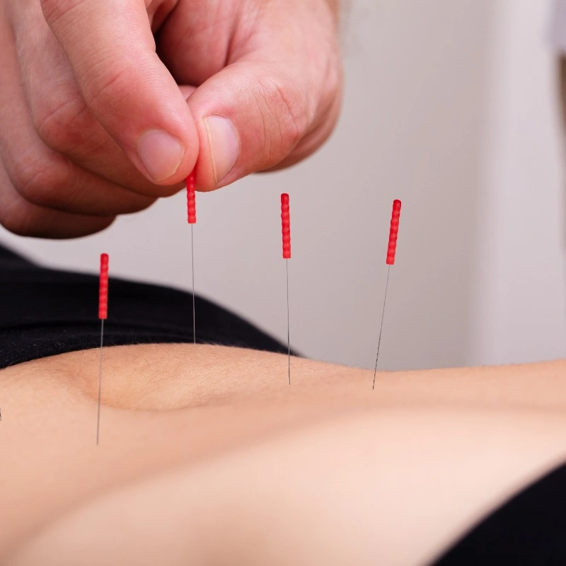 Acupuncture needles being placed in belly