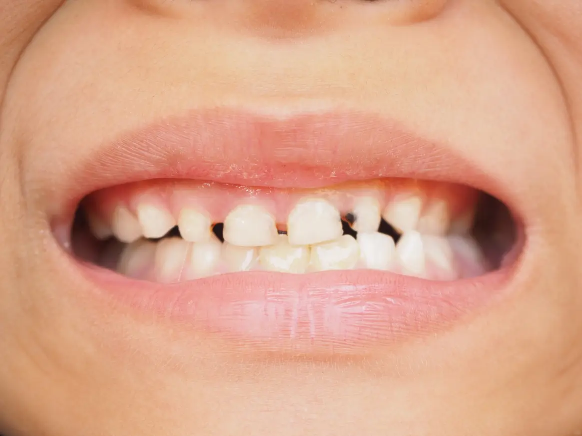 Image showing early stages of tooth decay in children.