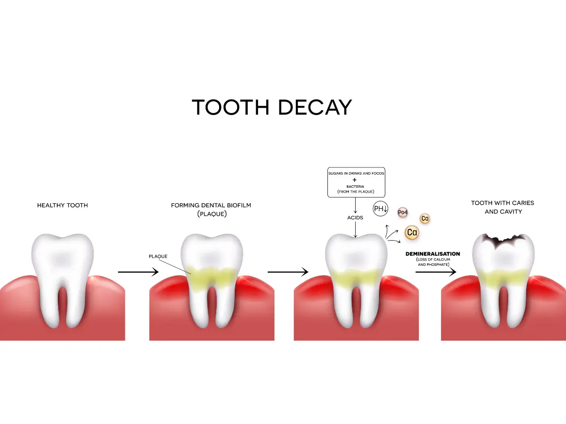 Illustration of  stages of children’s tooth decay from plaque formation to caries and cavity.