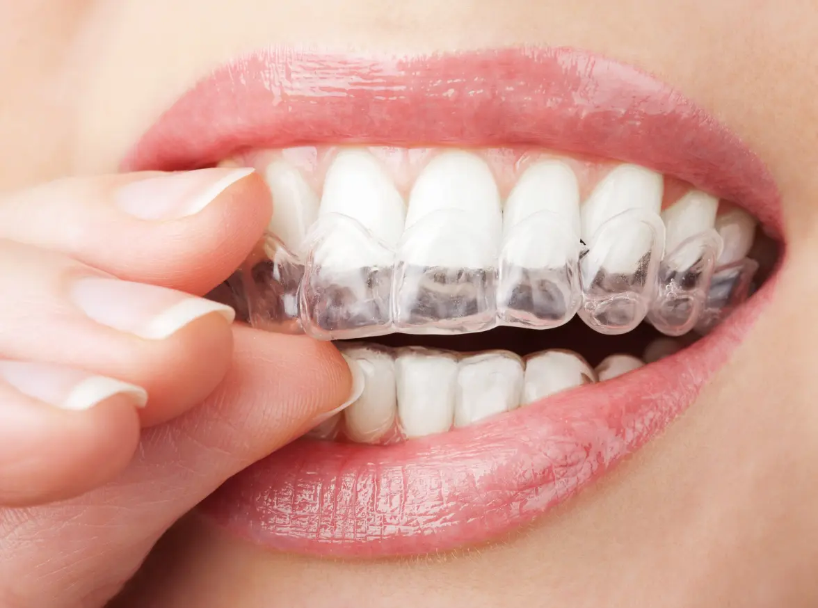 Photo of a lady inserting a clear aligner tray to their upper teeth.