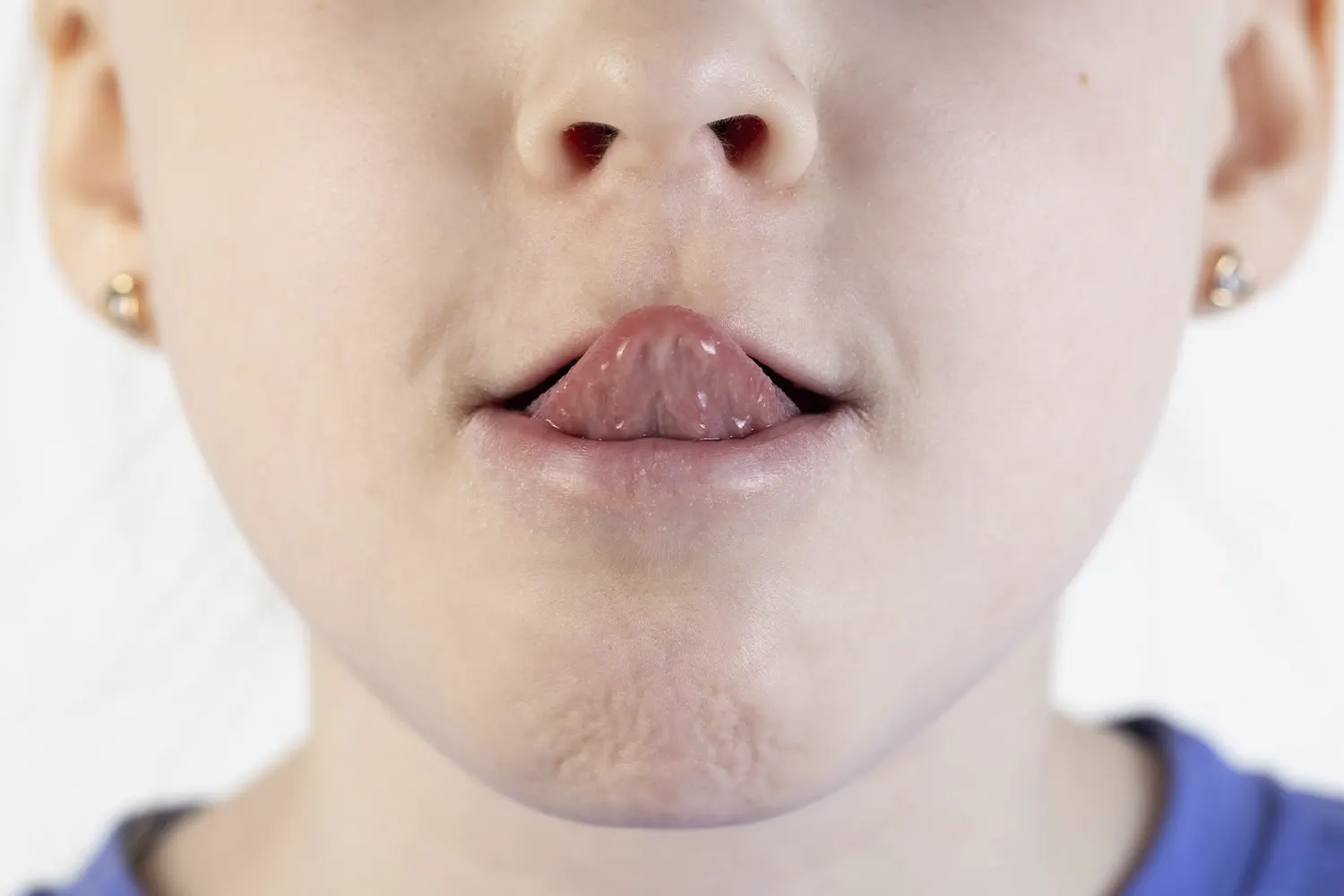 Laser Frenectomy vs. Traditional Clipping