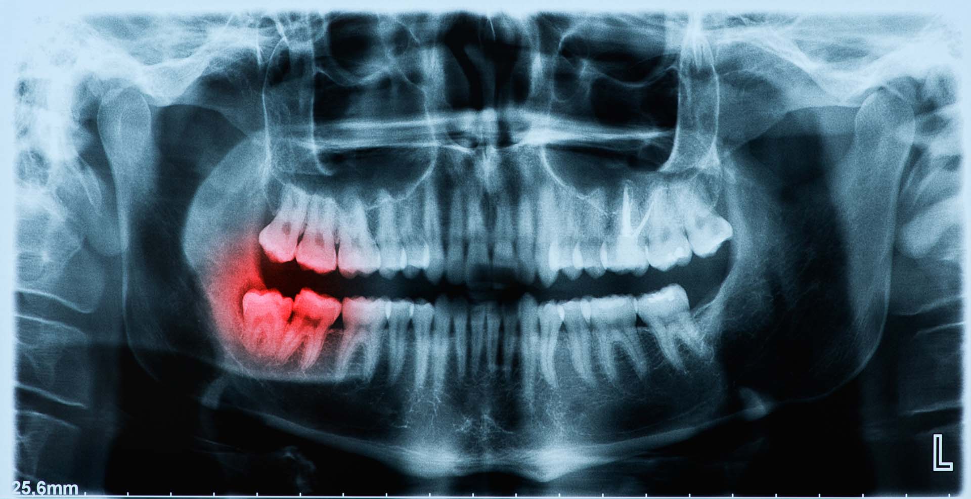 Minor Oral Surgery