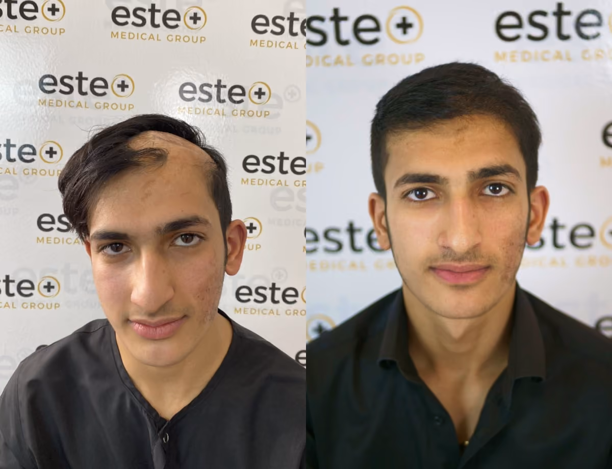 Hair transplant before and after Leeds